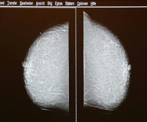   مصر اليوم - دراسة تشكك بجدوى فحص الثدي بالأشعة